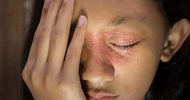 skincare tips for people with eczema