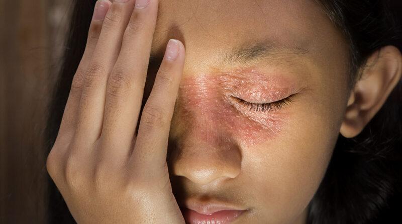 skincare tips for people with eczema