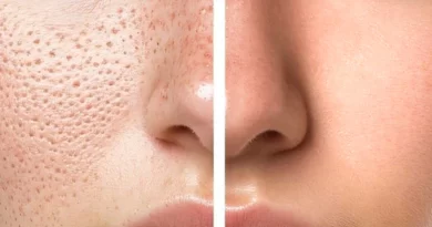 how to reduce large pores on nose permanently