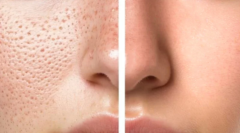 how to reduce large pores on nose permanently