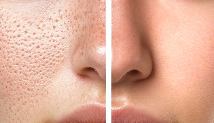 how to reduce large pores on nose permanently