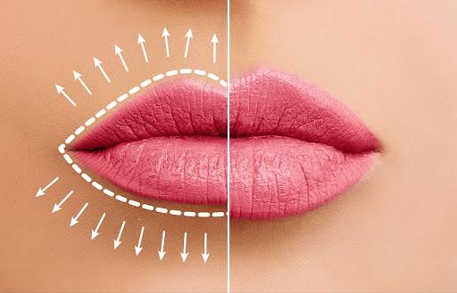 How Hyaluronic Acid Can Reshape Your Lips