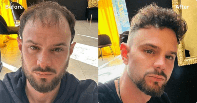 Are There Any Luxury Hair Transplant Clinics In Turkey?