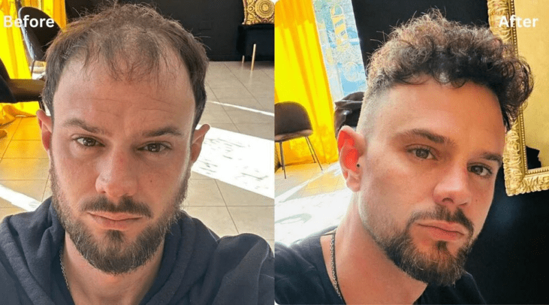 Are There Any Luxury Hair Transplant Clinics In Turkey?