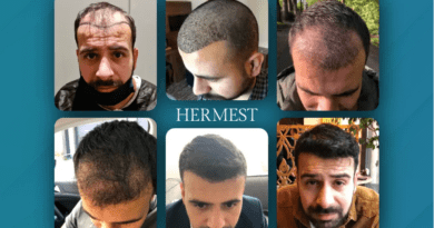 What Determines Hair Transplant Success Rate? And Why Some Clinics Reach 99%