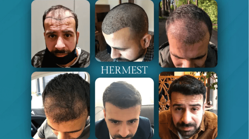 What Determines Hair Transplant Success Rate? And Why Some Clinics Reach 99%