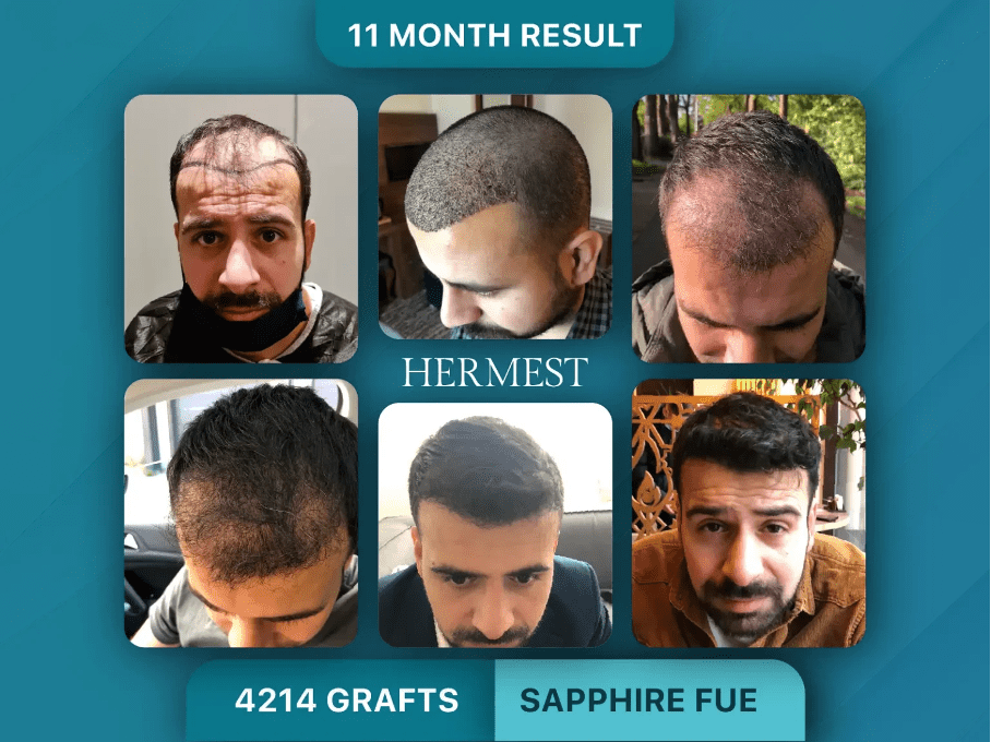 What Determines Hair Transplant Success Rate? And Why Some Clinics Reach 99%