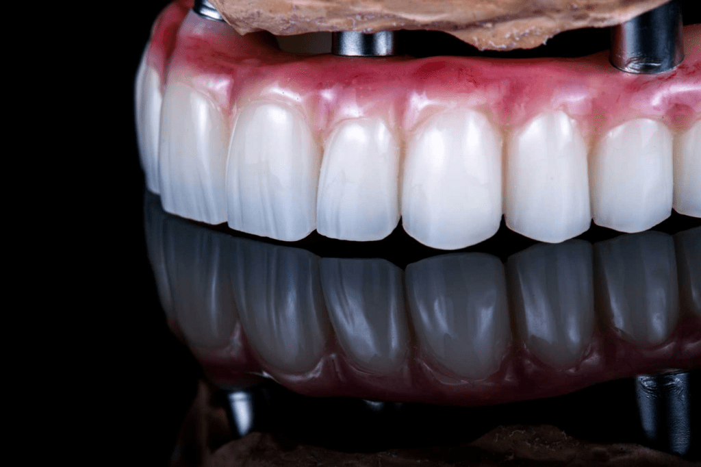 The Smile Investment: Why Full-Arch Implants Are the Quiet Luxury of Self-Care