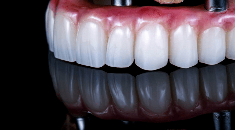 The Smile Investment: Why Full-Arch Implants Are the Quiet Luxury of Self-Care
