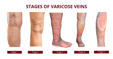 How to Find the Right Vein Specialist to Evaluate Leg Symptoms