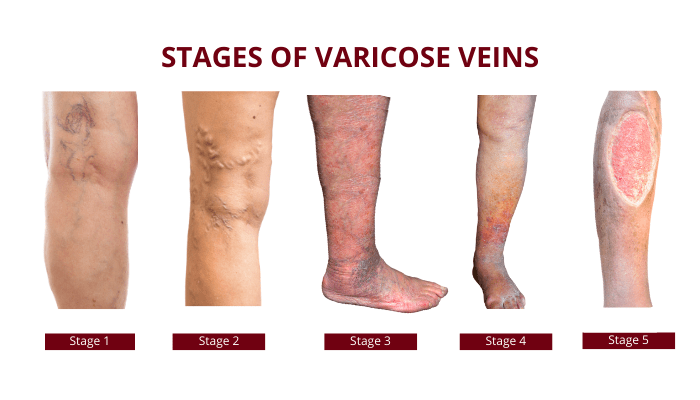 How to Find the Right Vein Specialist to Evaluate Leg Symptoms