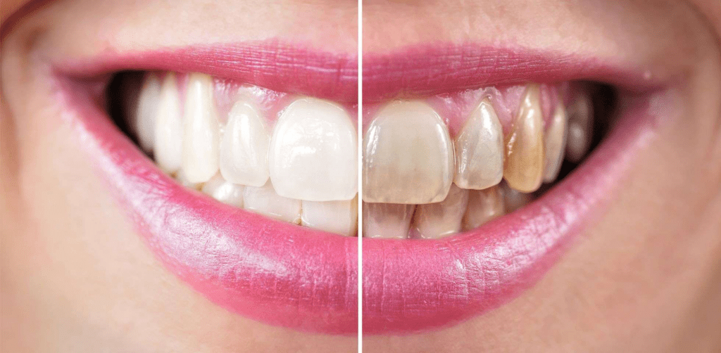 Teeth Whitening Manhattan Beach: What to Know Before Your First Treatment