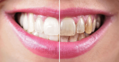 Teeth Whitening Manhattan Beach: What to Know Before Your First Treatment