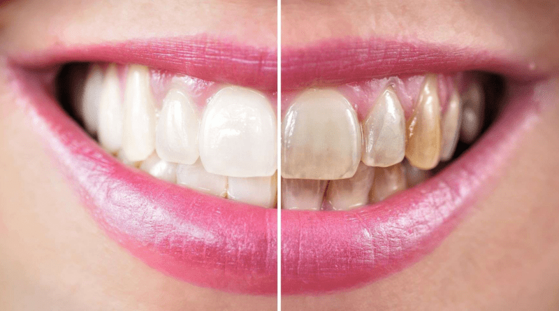 Teeth Whitening Manhattan Beach: What to Know Before Your First Treatment