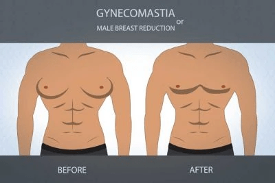 The Health Benefits of Breast Reduction That Deserve More Attention