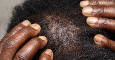 dandruff treatment