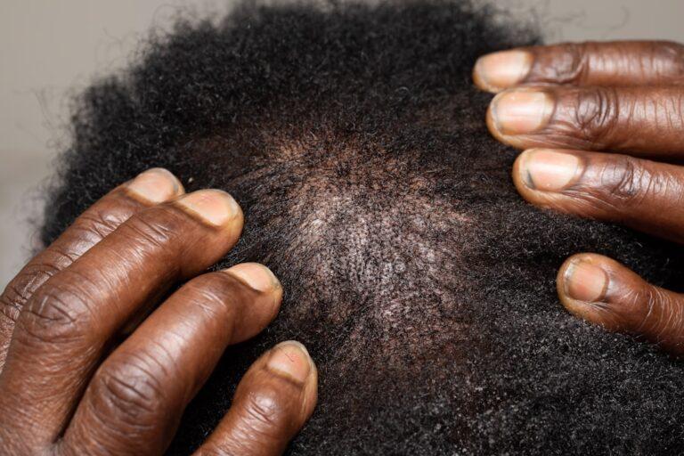 dandruff treatment