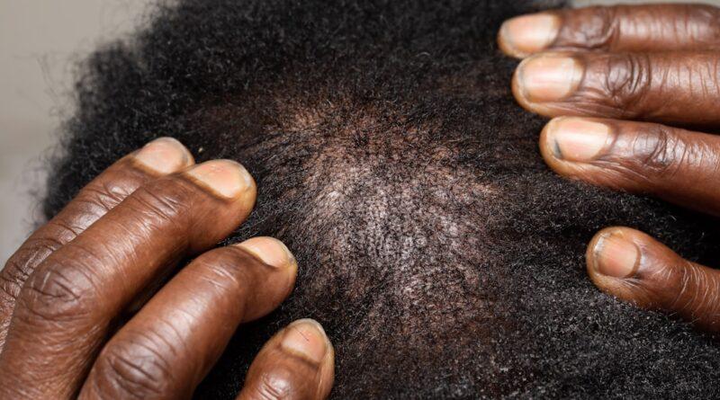 dandruff treatment