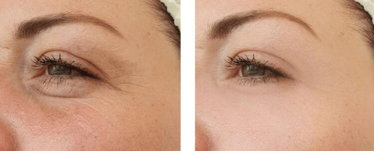 The Benefits and Applications of Rejuran Treatment