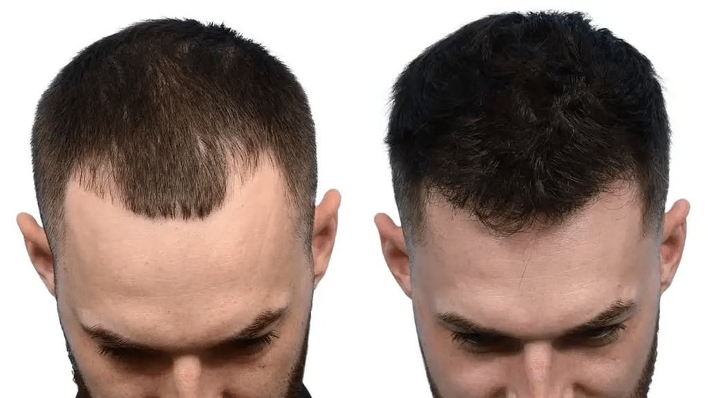 Modern Hair Transplant Options for Natural-Looking Results