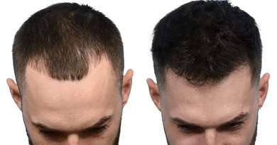 Modern Hair Transplant Options for Natural-Looking Results