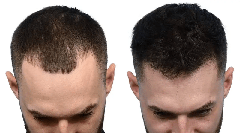 Modern Hair Transplant Options for Natural-Looking Results