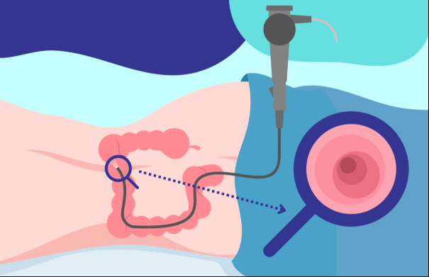 Colonoscopy
