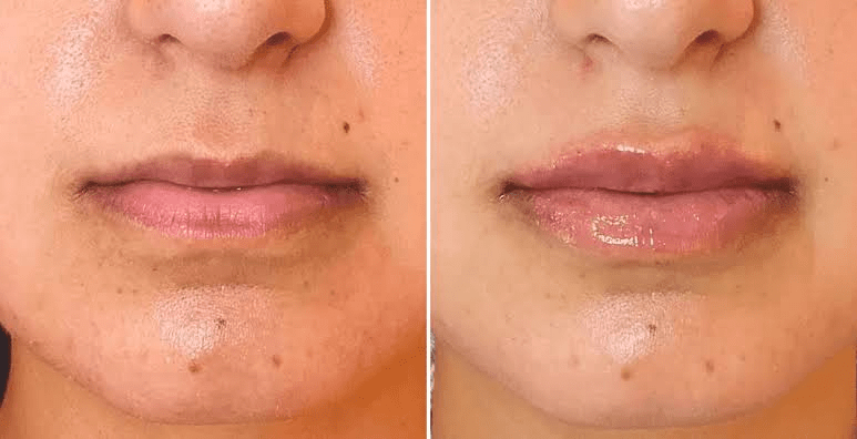 Filler Dissolving Explained: What to Know Before Reversing or Adjusting Dermal Filler