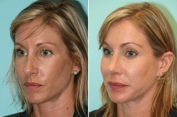 How Non-Surgical Skin Tightening in Ahwatukee Can Improve Skin Firmness 