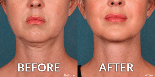 A Complete Guide to Skin Tightening Treatments in Phoenix, AZ