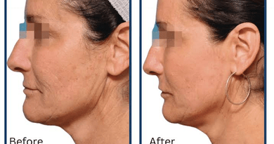 The Nd:YAG Laser: Why One Wavelength Works on Every Skin Tone