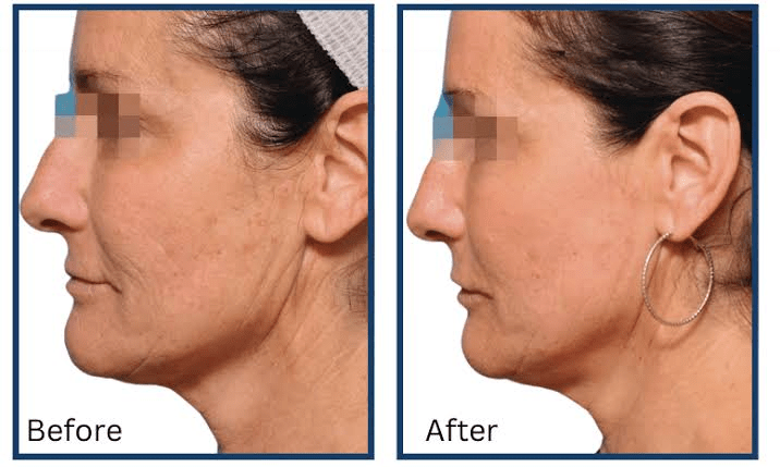 The Nd:YAG Laser: Why One Wavelength Works on Every Skin Tone