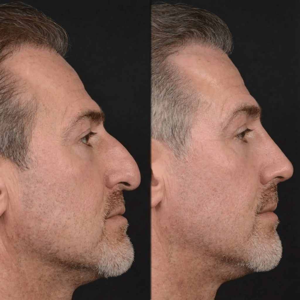 Nose Job Cost in Turkey vs the UK: What the Price Difference Does and Does Not Buy