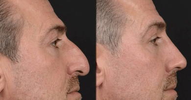 Nose Job Cost in Turkey vs the UK: What the Price Difference Does and Does Not Buy