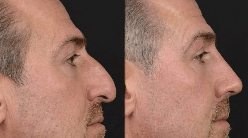 Nose Job Cost in Turkey vs the UK: What the Price Difference Does and Does Not Buy