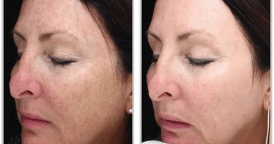 Where to Get Halo Laser Treatment Near Minneapolis