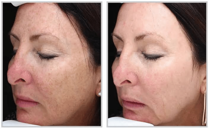 Where to Get Halo Laser Treatment Near Minneapolis