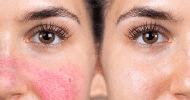 Rosacea Treatment: Why the Redness Keeps Coming Back and What Controls It