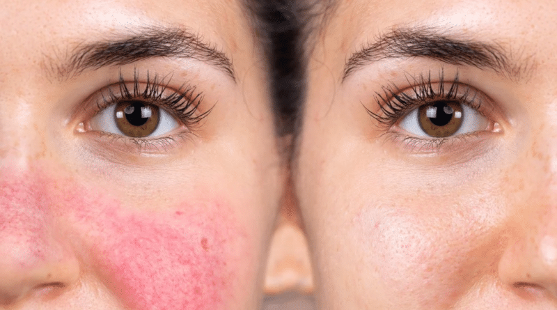 Rosacea Treatment: Why the Redness Keeps Coming Back and What Controls It