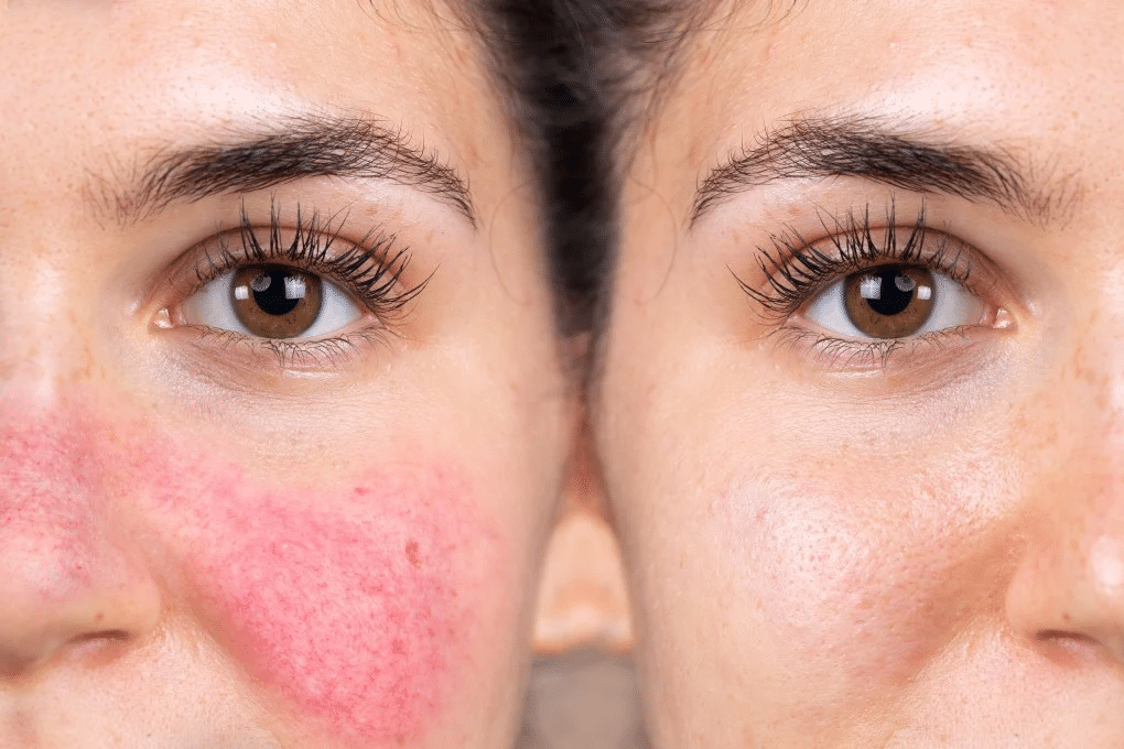 Rosacea Treatment: Why the Redness Keeps Coming Back and What Controls It