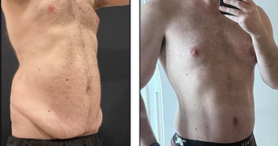 Which Tummy Tuck Do You Need? Mini, Full, Extended and Muscle Repair Explained