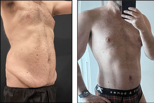 Which Tummy Tuck Do You Need? Mini, Full, Extended and Muscle Repair Explained