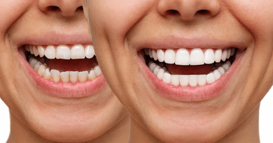 Cosmetic Dentistry 101: From Professional Whitening To Full Smile Makeovers