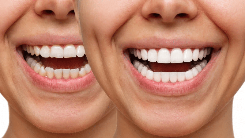 Cosmetic Dentistry 101: From Professional Whitening To Full Smile Makeovers