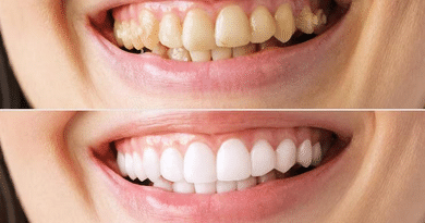Transforming Your Smile: Everyday Whitening to Complete Smile Restorations