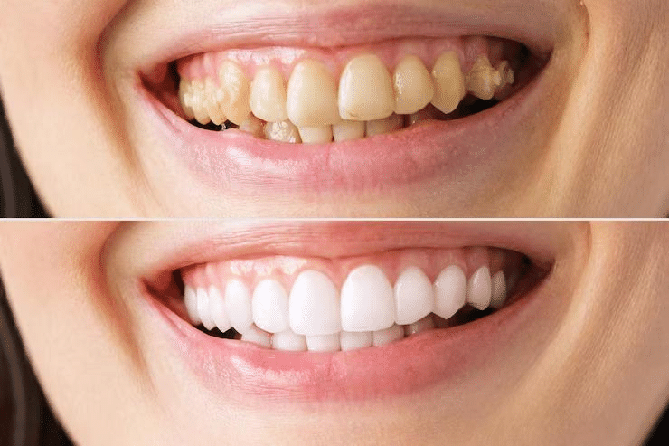 Transforming Your Smile: Everyday Whitening to Complete Smile Restorations