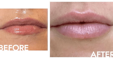 Are Your Lips Losing Definition With Age? What to Know About Lip Fillers