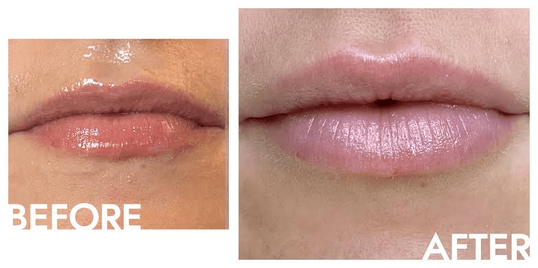 Are Your Lips Losing Definition With Age? What to Know About Lip Fillers