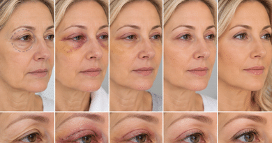 Understanding the Different Healing Stages After Blepharoplasty